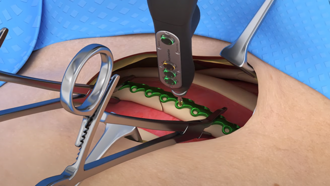 Thumbnail Video - Reconstruction of a fractured rib