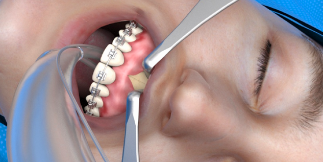 L1® MI Orthognathics - Maxilla - OP-Szene