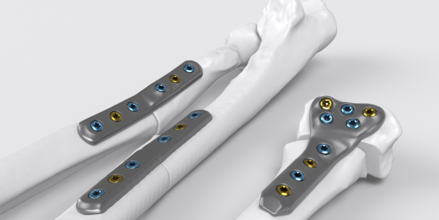 IPS Forearm Reconstruction - Plates on bone