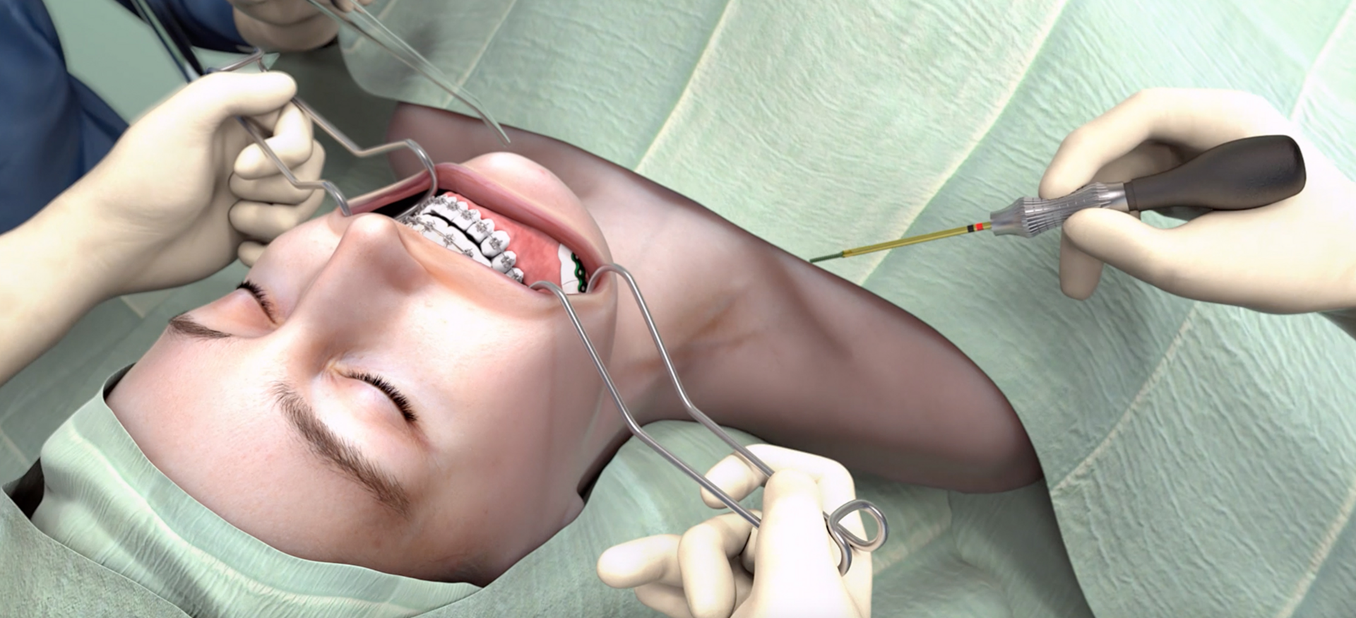 Photorealistic rendering of a surgery scene