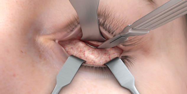 IPS Implants® Midface Orbita - OR Scene