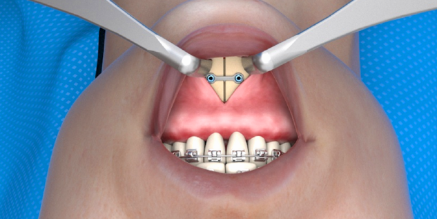  L1® MI Orthognathics - Mandible - OR Scene