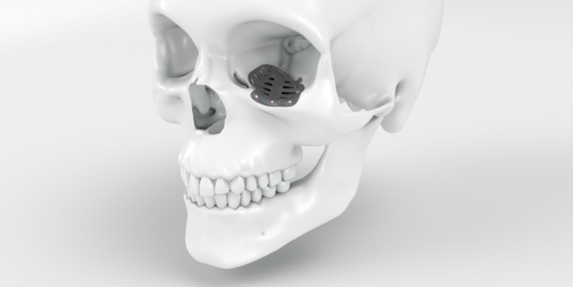 IPS Implants® Midface Orbita - Platte auf Schädel