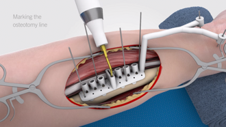 Thumbnail Video - Cutting and drilling guide on bone